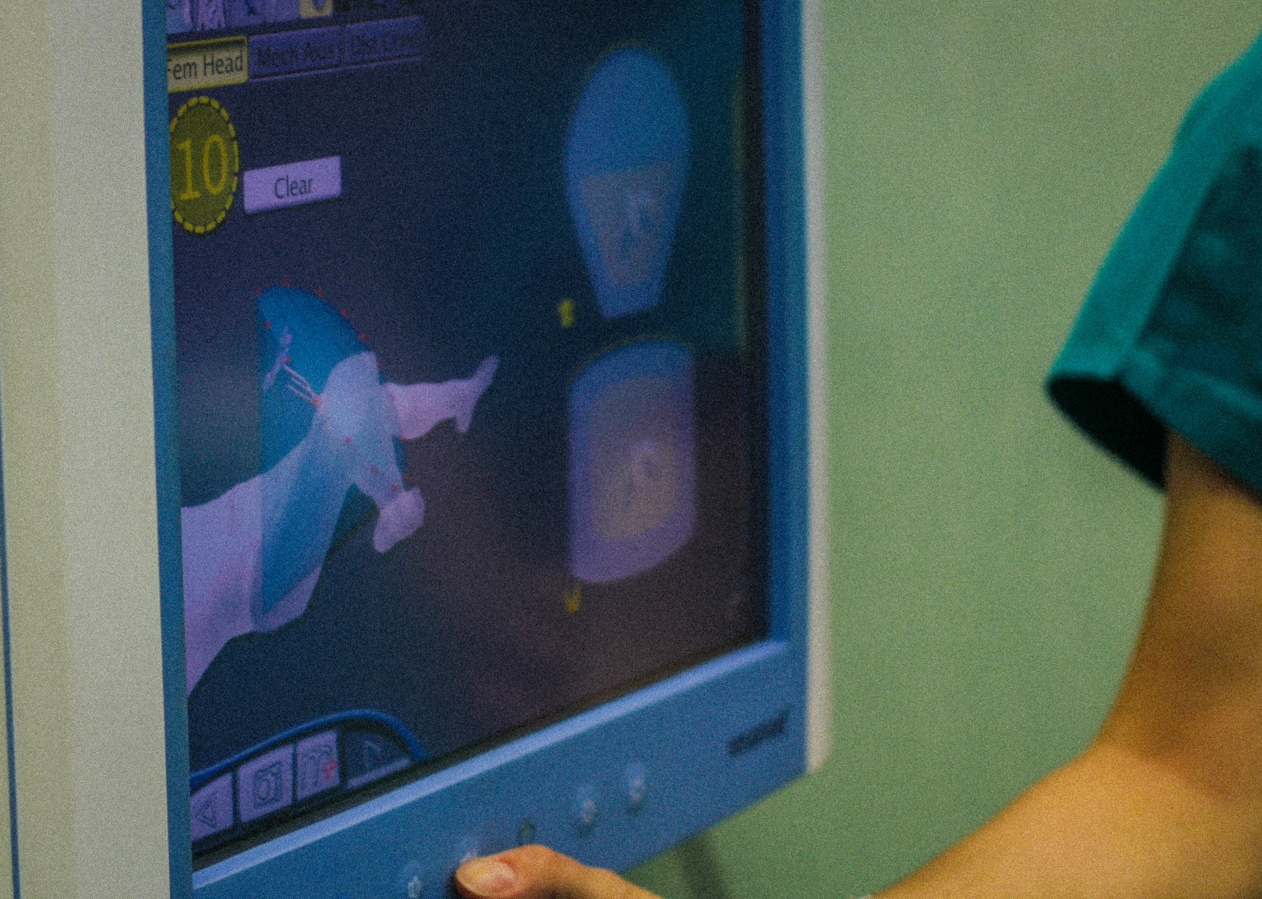 Protesi di ginocchio robotica: precisione e legamenti bilanciati