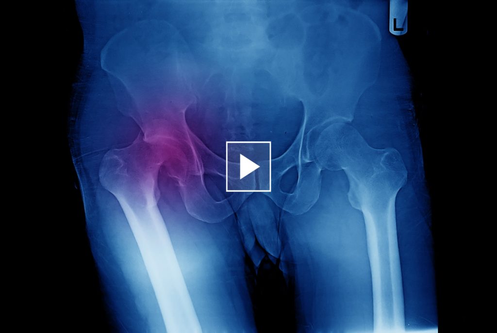 protesi anca superficie